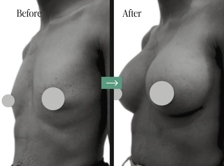 Screenshot 2024-10-10 at 9.14.58 PM Breast Implant Removal Before and After Pictures Charleston, SC